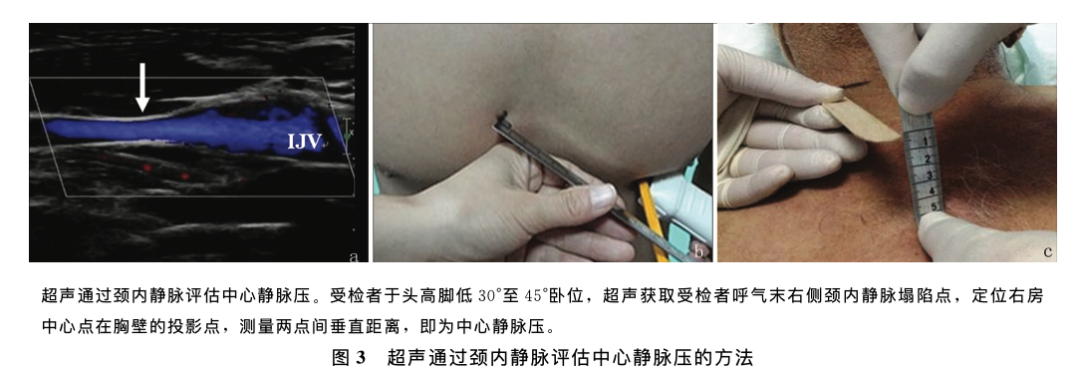 腹部及外周静脉血管超声若干临床常见问题专家共识(图3)
