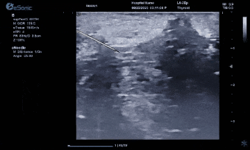 穿刺.gif