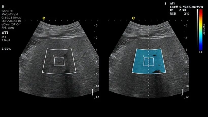 别等肝受损！E超“四道防线”精准守肝(图3)