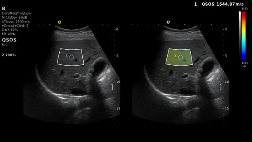 别等肝受损！E超“四道防线”精准守肝(图4)