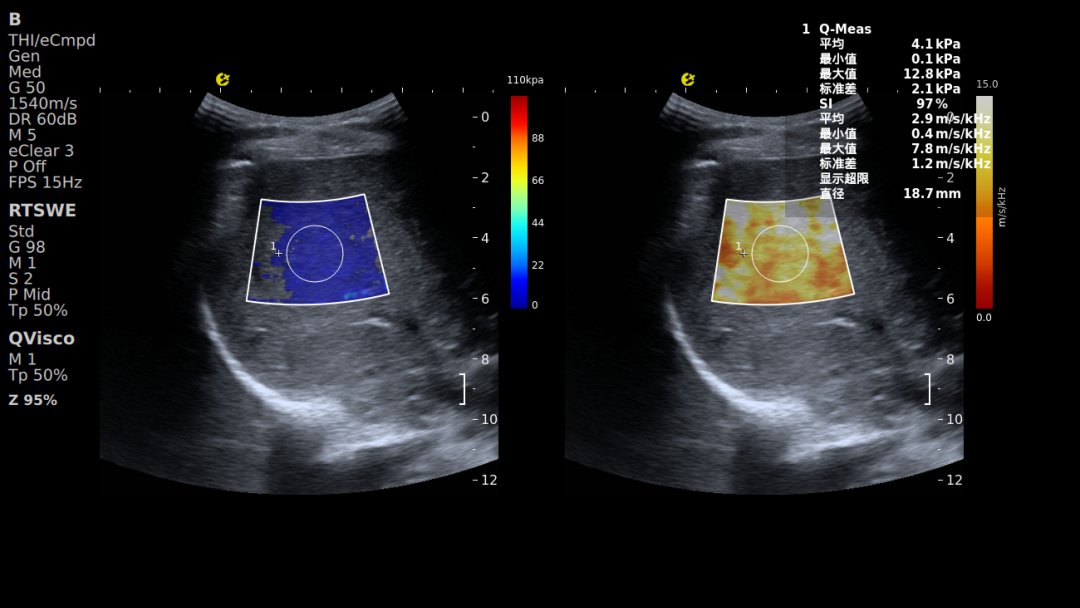 别等肝受损！E超“四道防线”精准守肝(图5)