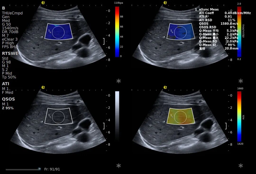 别等肝受损！E超“四道防线”精准守肝(图7)