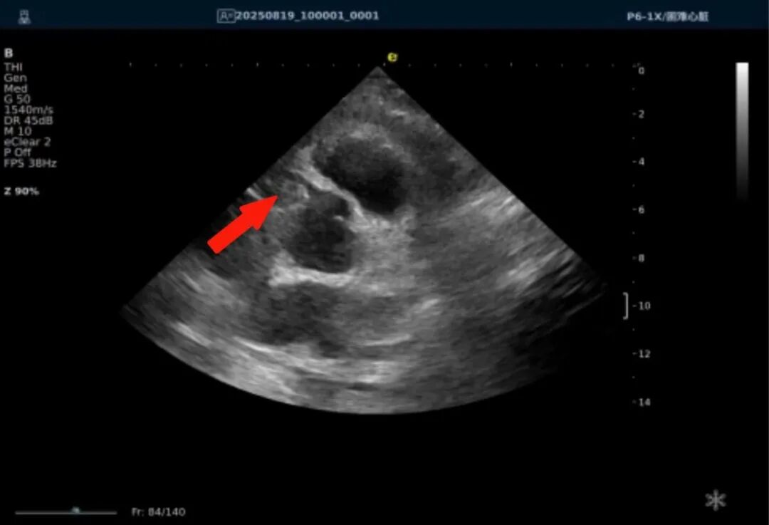 从近期“心源性猝死”高发看健康危机，您的冠脉还好吗？(图15)