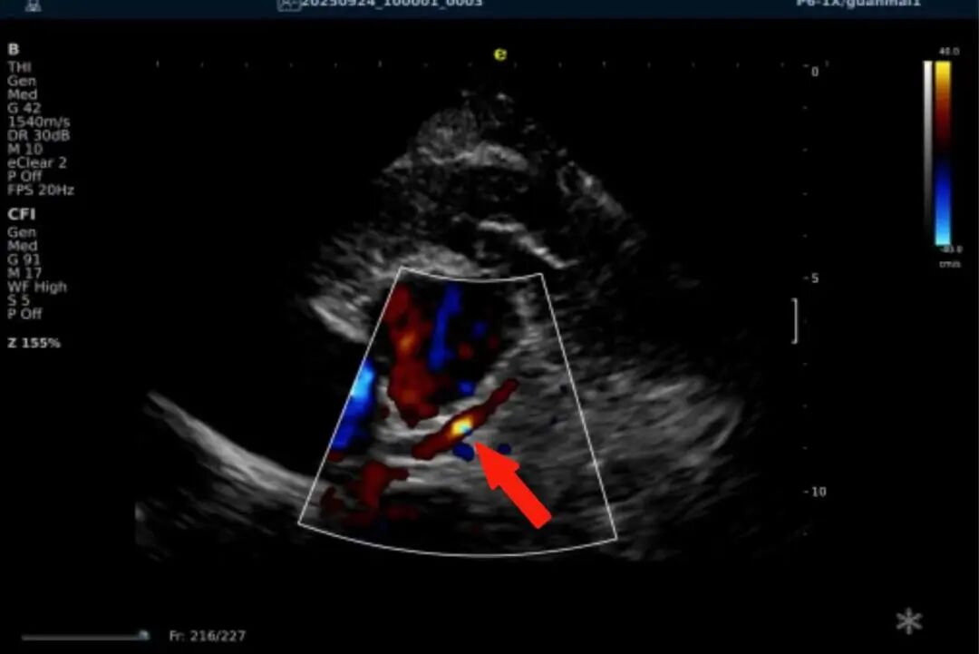 从近期“心源性猝死”高发看健康危机，您的冠脉还好吗？(图17)