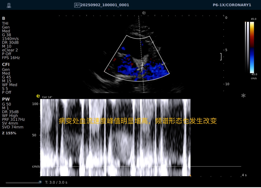 从近期“心源性猝死”高发看健康危机，您的冠脉还好吗？(图29)